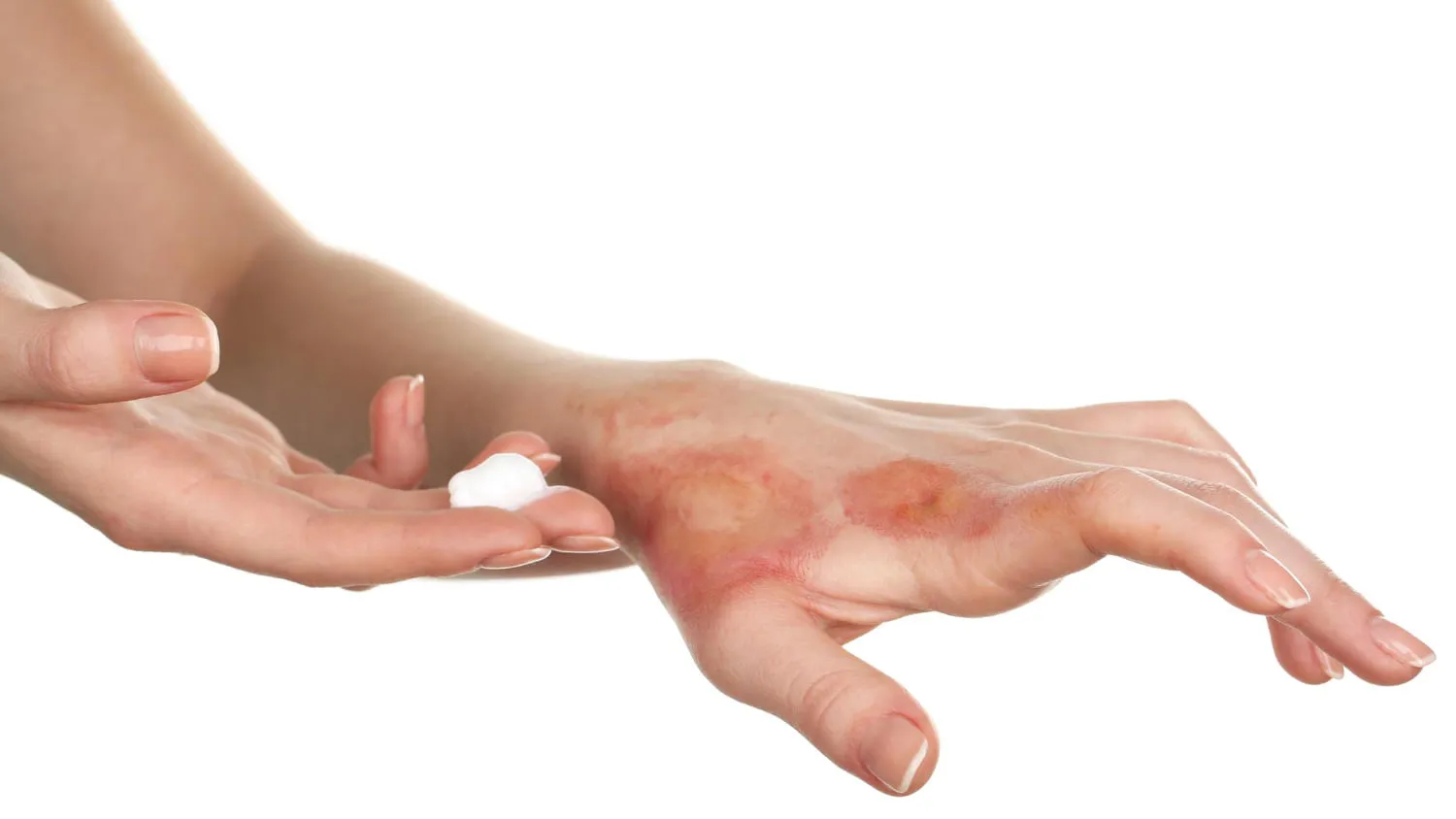 A superficial burn healing on the back of a hand, with burn cream about to be applied