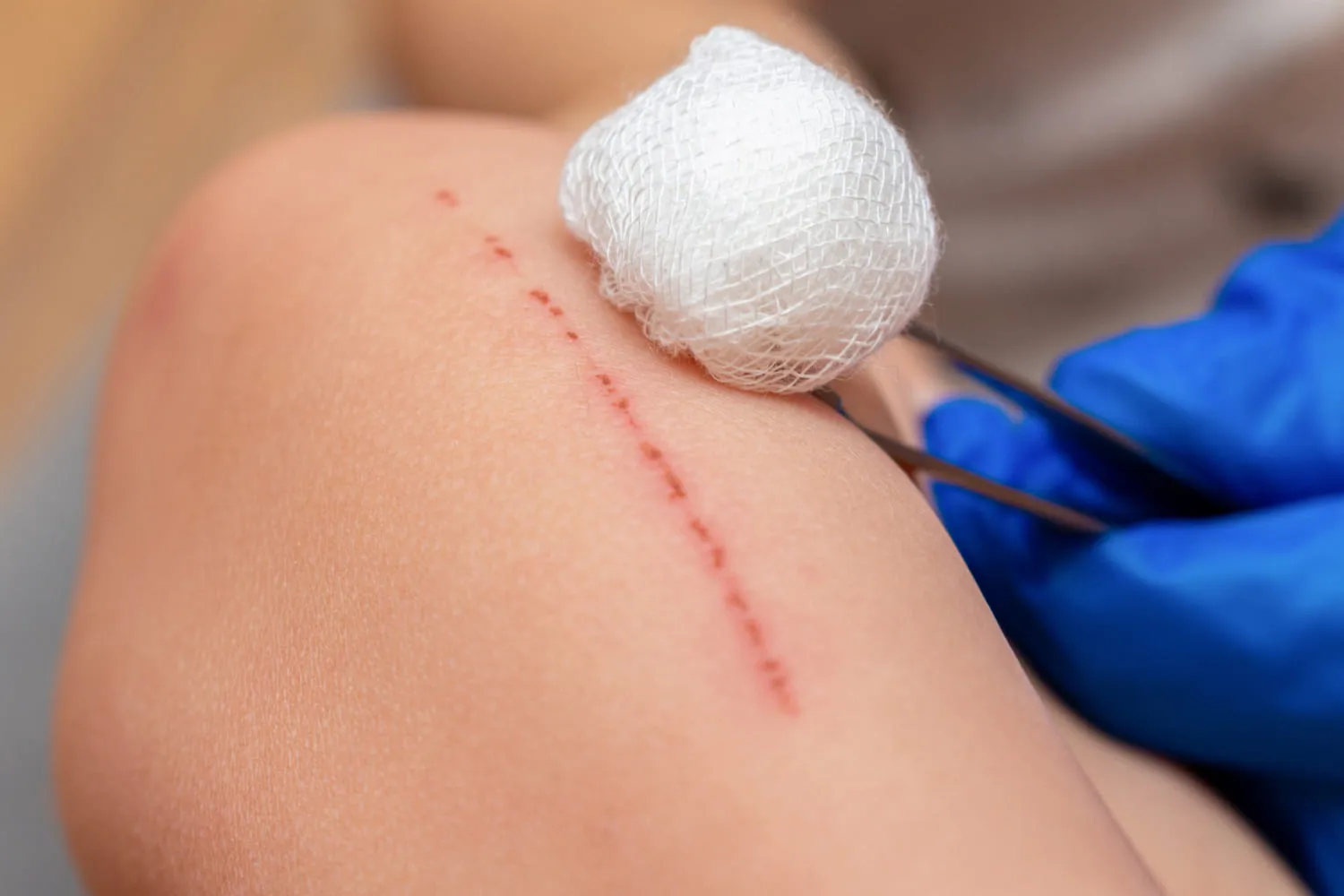 A sutured wound on a patient's leg being dressed with sterile gauze